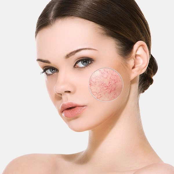 Система профессионального ухода за кожей, склонной к куперозу