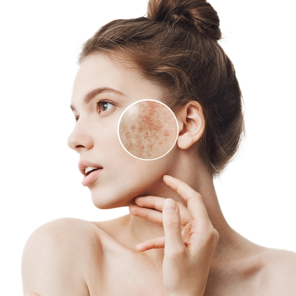 Программы коррекции гиперпигментации. От анатомии к практике