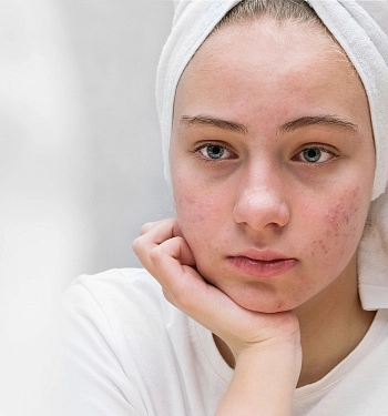 «Цветущий сад»: как правильно ухаживать за проблемной кожей