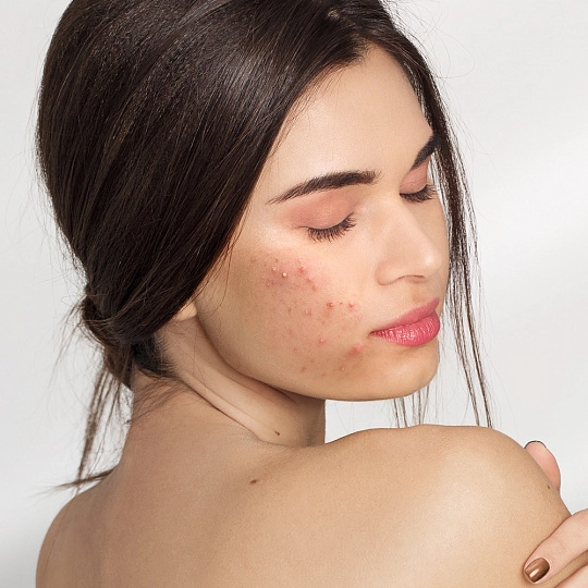 Как правильно ухаживать за чувствительной кожей лица?